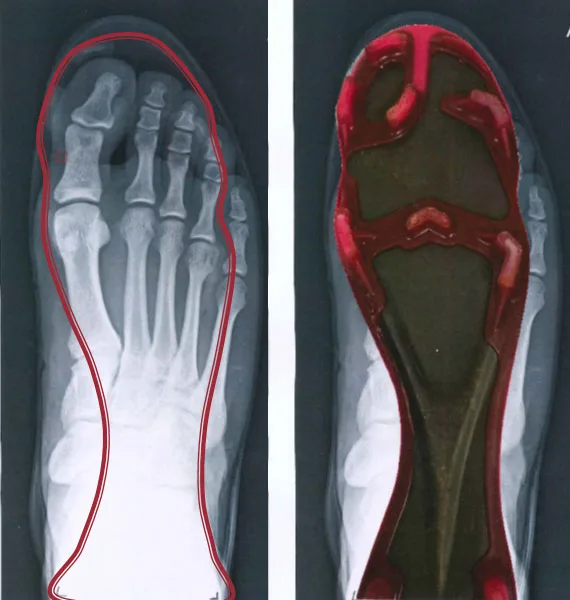 Image radio du pied avec port de crampon